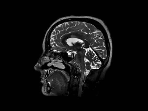 3D T2 brain MRI imaging