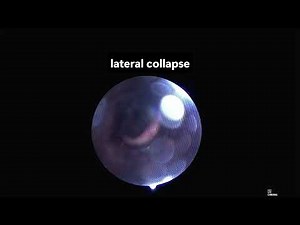 Sleep Endoscopy Presentation – Multifactorial Airway Obstruction