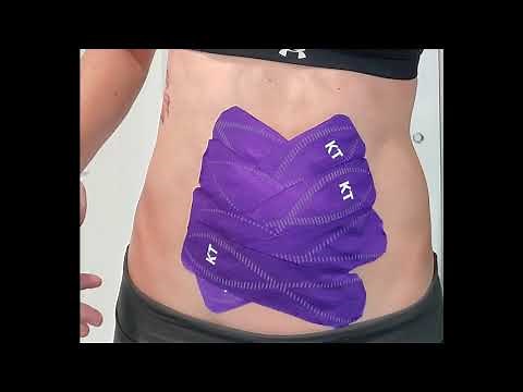 Taping for diastasis recti: criss cross method | Connect PT