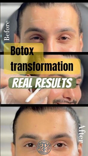 Botox Transformation: Before, During & After ✨ | Natural Results