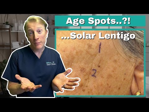Age Spots: Getting Rid of Solar Lentigo