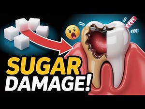 Acid Attack: How Sugar Destroys Your Teeth | Dental Animation Explains Cavity Formation