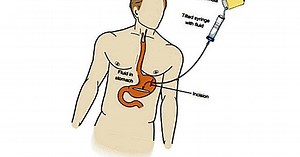 Enteral nutrition: types, definition and uses with patients - yes, therapy helps!