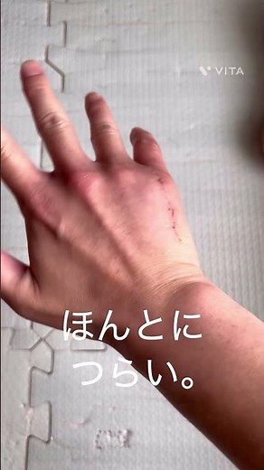 小指第五中手骨骨折(ボクサー骨折)プレート内固定手術1ヶ月後