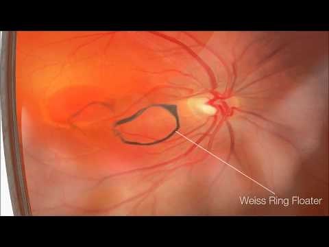 飛蚊症治療 硝子体YAGレーザー