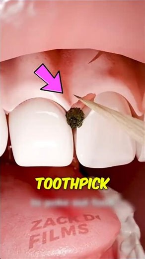 Why Using a Toothpick Is Secretly Damaging Your Teeth 😬 What to Use Instead!