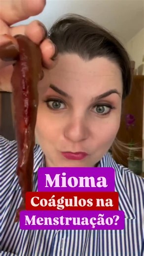 Dra. Ariane Dembogurski | Miomas on Instagram: "🟢 🩸 Você já reparou coágulos ou até “grumos” na sua menstruação? Isso é muito comum quando existe deficiência de progesterona, o hormônio que protege o útero dos miomas e mantém o endométrio saudável 💗 ⚠️ Quando a progesterona está baixa, é comum aparecer: 🔴 Sangue com pedaços e coágulos ☕ Fluxo em forma de borra de café 📆 Menstruação irregular e mais intensa ✨ Mas existe solução! É possível ativar a nossa fábrica natural de progesterona de fo