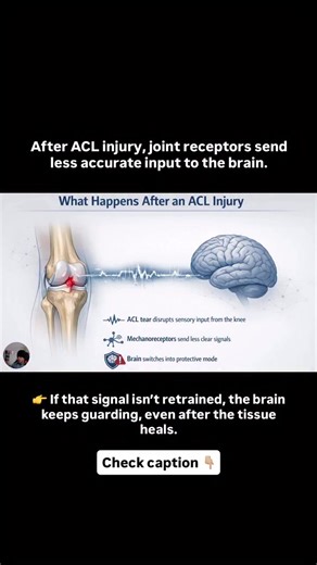 Understanding ACL Injury: Brain Response and Recovery