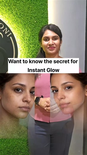 𝐉 𝐎 𝐍 𝐈 Signature Salon on Instagram: "✨ Carbon Peel Laser Treatment ✨ Dull skin. Excess oil. Open pores. Acne marks. Stop covering it — fix it. Our Carbon Peel works deep into the pores to: ✔ Control oil & acne ✔ Reduce pigmentation & tan ✔ Tighten pores ✔ Improve skin texture ✔ Boost instant glow Safe • Non-invasive • Minimal downtime 📍 Joni Signature Salon & Aesthetic Wellness – Selaiyur 📞 90030 03670 DM / Call to book your session #CarbonPeel #LaserFacial #SkinTreatmentChennai #AcneCar