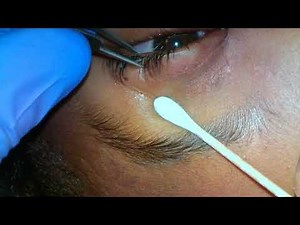Botulinum toxin (Botox) injection to the lacrimal gland
