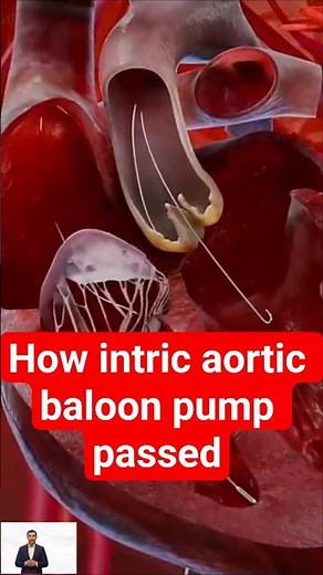 3D Animation: Intra-Aortic Balloon Pump (IABP) Procedure Explained | How IABP Supports the Heart