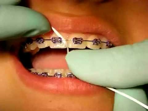 Bracesquestions.com - Flossing With Braces, How to Floss Teeth