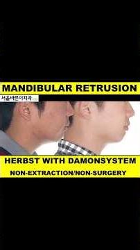 Mandibular retrusion:Herbst with Damon System(2)