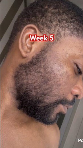 From Week 1 to 6 – Minoxidil Beard Transformation. #shorts #beardgrowth