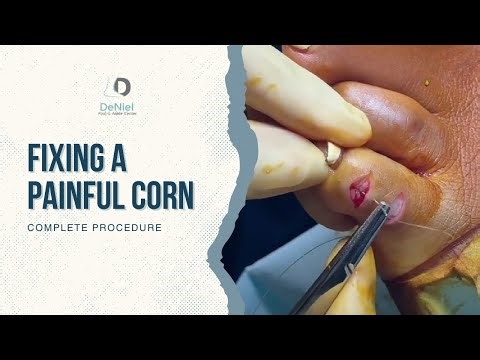 Watch This Corn Disappear! | Corn Excision Procedure