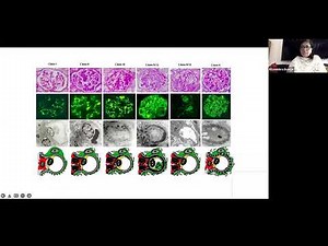 Basics of Renal Pathology : Lupus Nephritis