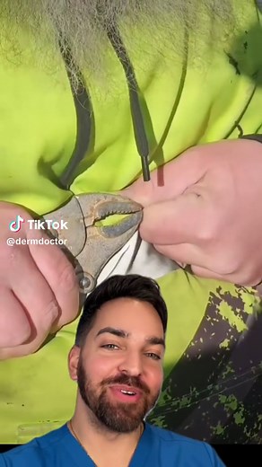 The rules are the rules @CallMeCrazy5150 #dermdoctor | giant splinter removal