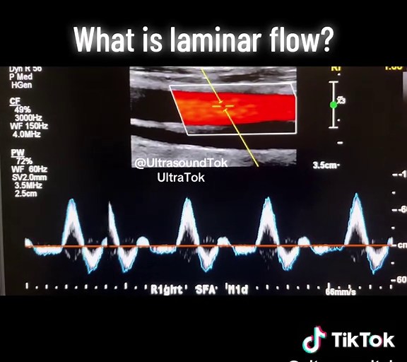 Arterial Duplex/ Spectral Doppler Triphasic flow What is laminar flow? Laminar flow occurs when a fluid (like water, oil, or blood) flows smoothly in parallel layers, or
