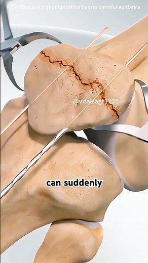 How Patella Fracture Surgery Is Performed？ (3D Animation) #kneepain #kneesurgery #doctor #facts