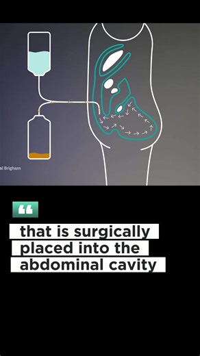 💧💉 Peritoneal Dialysis: Harnessing the Power of the Abdominal Cavity! 🌟🔬 This method utilizes a surgically placed catheter to infuse and remove dialysis fluid, providing kidney care. 👨‍⚕️🏥 Discover the benefits, process, and empowerment it brings to patients. 🌈💙 Let's dive into the world of peritoneal dialysis together! 💪✨ #PeritonealDialysis #AbdominalCavity #KidneyCare #DialysisFluid #Empowerment #MedicalAdvancements #HealthAndWellness #SharingKnowledge #HealthJourney #SEOExpert