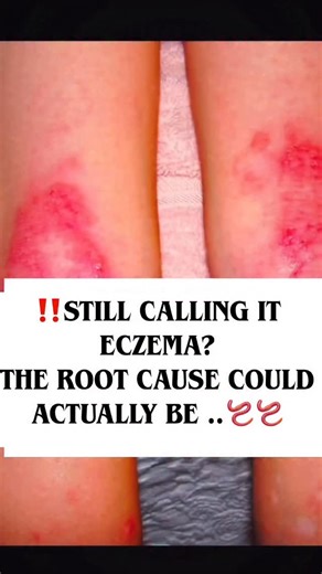 The TESTIMONIALS from parents are 🥹🥹‼️ Watch video to end for them .. So what IF it’s not “just eczema, ⚠️ but a sign of toxicity, parasites, and overload building up beneath the surface. If your skin or YOUR kids is screaming, it’s the body trying to talk to you Follow @stronglowtoxmom for tips on aging strong, detoxing properly & thriving Most people don’t even realize that eczema, rashes, and chronic skin issues are often parasite-related. Parasites release mycotoxins and waste that overloa