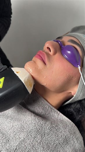 Comfortable Laser Hair Removal Experience in Birmingham