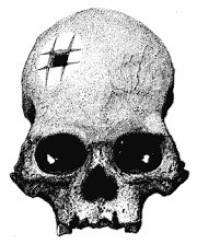 History of trepanation