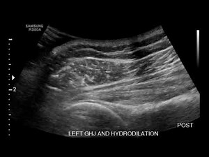Shoulder Ultrasound: Demonstration of Needle Placement