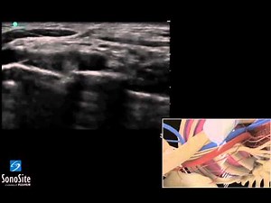 3D Comment: Bloc Supraclaviculaire échoguidé - échographe SonoSite