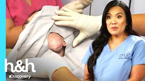 A handsome young man appears insecure about life because of a large lump on the side of his right cheek. | Dr. Sandra Lee: Skin Specialist | Discovery H&H 2711 #pimple #popper #drpimplepopper #drsandralee | Pimple Daily Post
