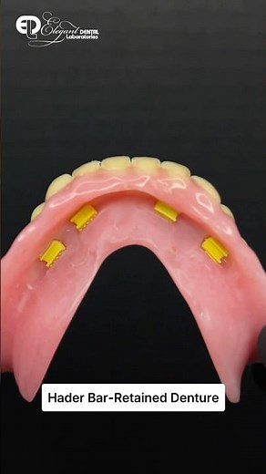 Hader Bar-Retained Dentures: Stability Meets Comfort