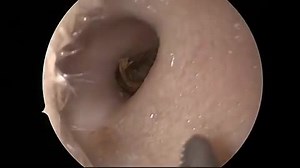Removal of object from ear
