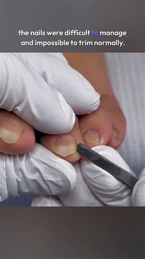 Nail Art on Instagram: "heavy nails get a fresh start #toenailcare #foothealth #nailtrim #trending #viral"