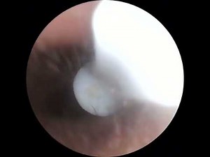 Soulear - Cleaning My Ears With Camera Part 2