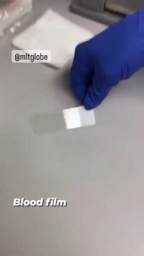 6.9K views · 356 reactions | Blood film 喝 | Medical Lab Technology - MLT Globe | Facebook