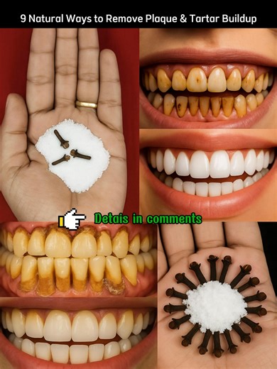 9 Natural Ways to Remove Plaque & Tartar Buildup | Health Recipe Collection