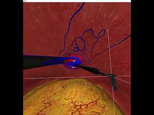 Virtual Electrosurgical Skill Trainer (VEST): Module 2 - Capacitive Coupling