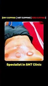 Cupping Specialists |✅ Natural Pain Relief and Detox Therapy