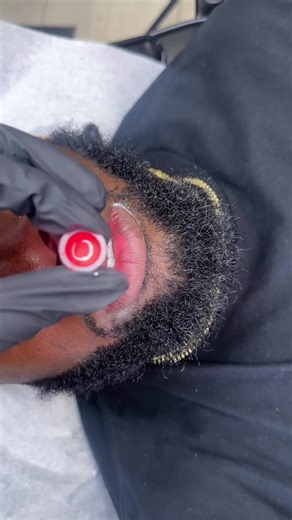 Effective Bottom Lip Neutralization Techniques