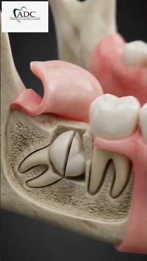 Wisdom Tooth Removal With AI