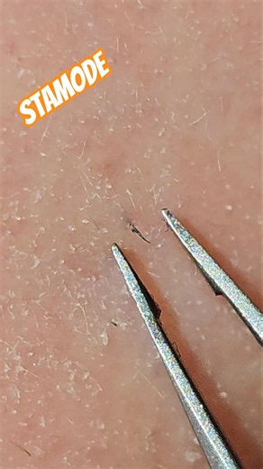 Deep Stuck Hair — That Final Clean Pull 😬
