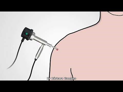 Arthroscopic Bankart Repair