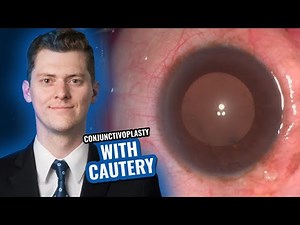 Conjunctivoplasty with Cautery
