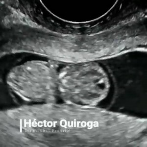A prenatal ultrasound test uses high-frequency sound waves, inaudible to the human ear, that are transmitted through the abdomen via a device called a transducer to look at the inside of the abdomen. With prenatal ultrasound, the echoes are recorded and transformed into video or photographic images of your baby. The ultrasound can be used during pregnancy to show images of the baby, amniotic sac, placenta, and ovaries. Major anatomical abnormalities or birth defects may be visible on an ultrasou