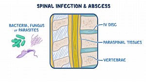 Video: Spinal infection and abscess: Clinical sciences - Video Explanation! | Osmosis | Osmosis