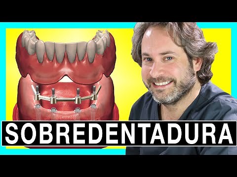 🔥𝐒𝐎𝐁𝐑𝐄𝐃𝐄𝐍𝐓𝐀𝐃𝐔𝐑𝐀 on 4 locator IMPLANTS [LOOK AT IT 👌] REMOVABLE PROSTHESIS on Implants
