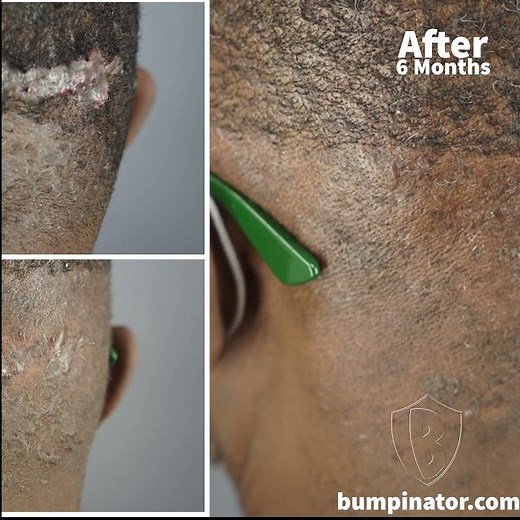 AKN Small Keloid Bumps & Lesions Laser Removal Before & After Results