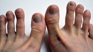 How To Prevent Bruised Toenails After Running