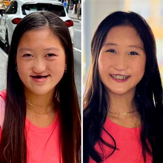 When Jade Metivier was 11 years old, her parents, Christi and Mark, noticed that the bones around her eyes and cheekbones weren’t growing properly, a congenital condition known as midface hypoplasia. As a result, Jade struggled with regular activities like eating, talking and smiling since she had a severe underbite. “You’re smiling on the inside, but not the outside,” says Christi. As a toddler, Jade had surgery for a cleft lip and palate, but the Metiviers knew her current condition would requ