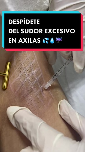 Toxina Botulinica para la Hiperhidrosis axilar, palmar, Su mecanismo de acción consiste en un bloqueo de la transmisión nerviosa en la unión neuromuscular #hiperhidrosisaxilar #axilassudorosas #sudoraxilas #hiperhidrosispalmar
